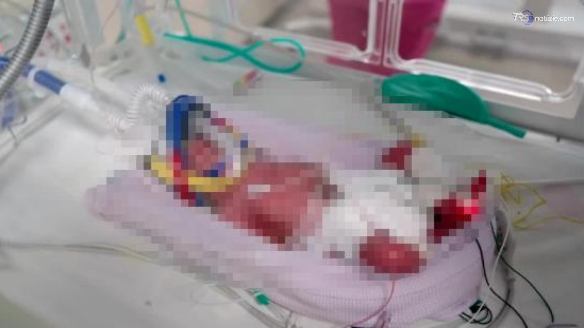 Australia, parto record: 4 gemelle identiche nella stessa placenta: "Un caso su 15 milioni"