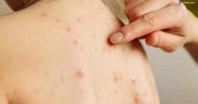 Morbillo negli Usa: quattro morti in Pennsylvania e 700 casi. Ultima vittima 18enne non vaccinato