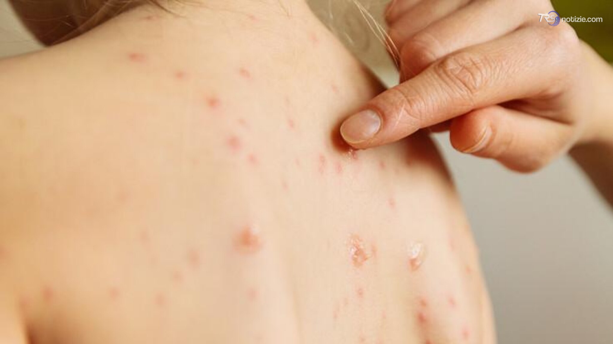 Morbillo negli Usa: quattro morti in Pennsylvania e 700 casi. Ultima vittima 18enne non vaccinato