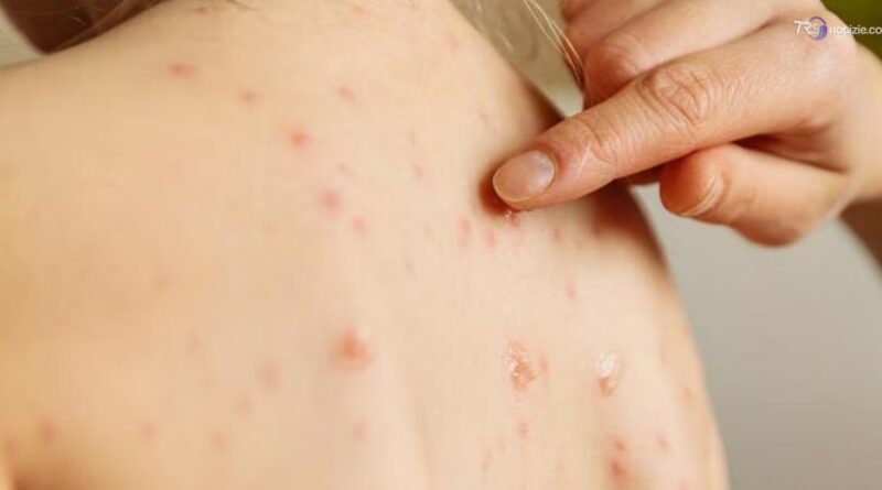 Morbillo, negli Usa torna l’allarme: in Pennsylvania oltre 970 casi e cinque morti